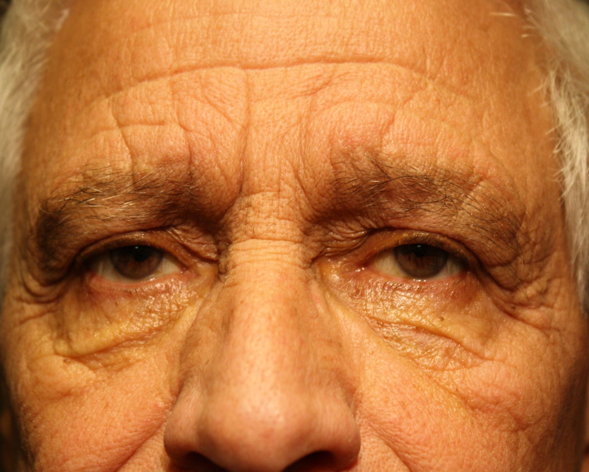 Chirurgie des paupieres inferieures