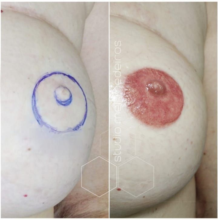 Reconstruction des Aréoles- Melissa Medeiros - Mell Medeiros