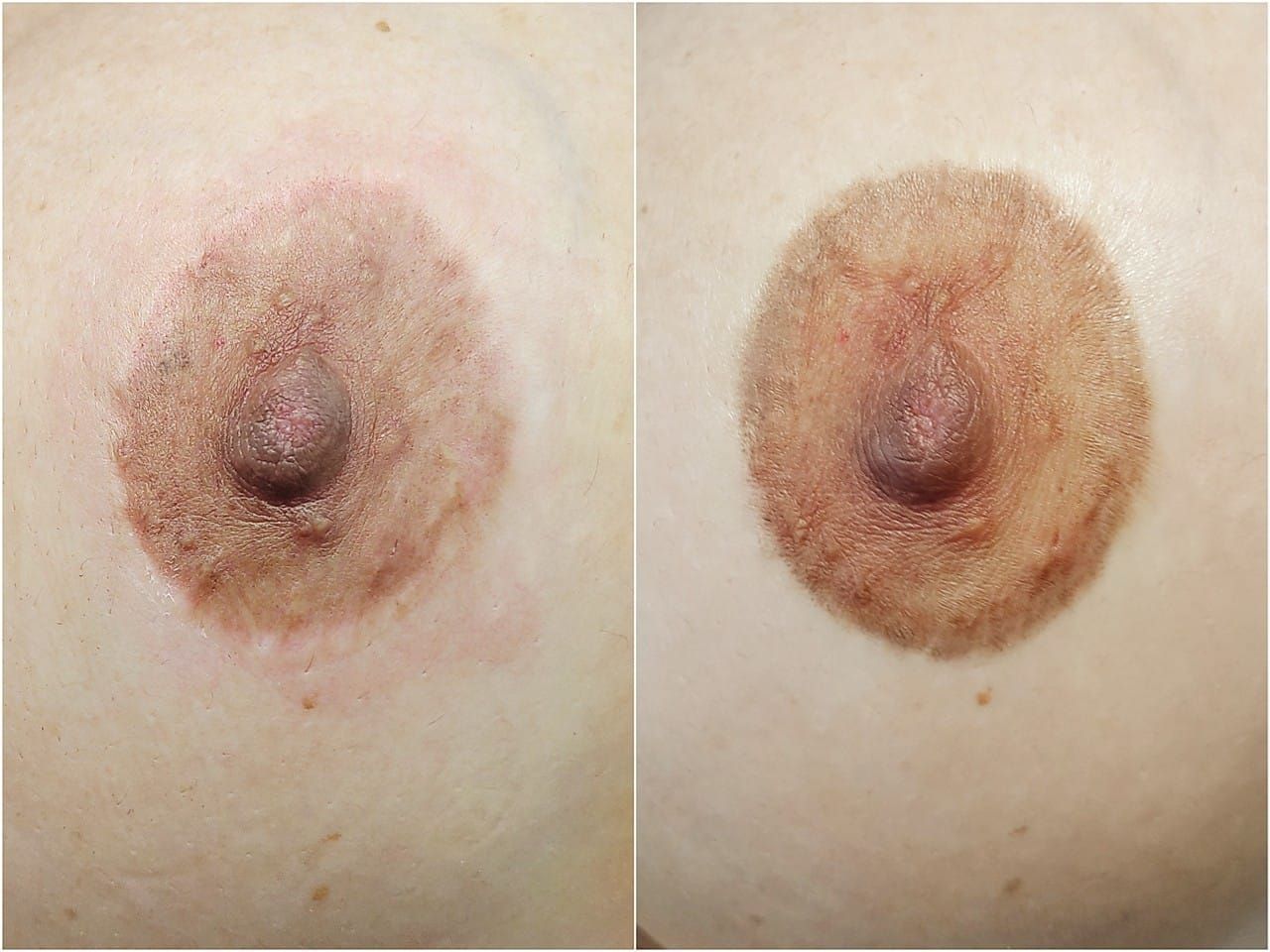 Reconstruction des Aréoles - Melissa Medeiros - Mell Medeiros