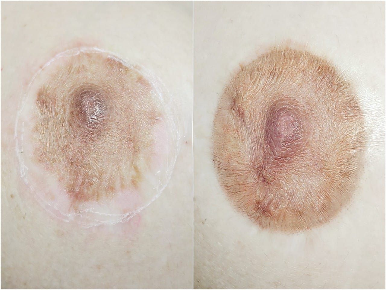 Reconstruction des Aréoles- Melissa Medeiros - Mell Medeiros