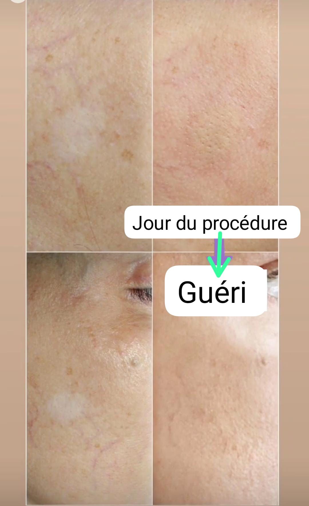 Camouflage de la peau - Melissa Medeiros - Mell Medeiros