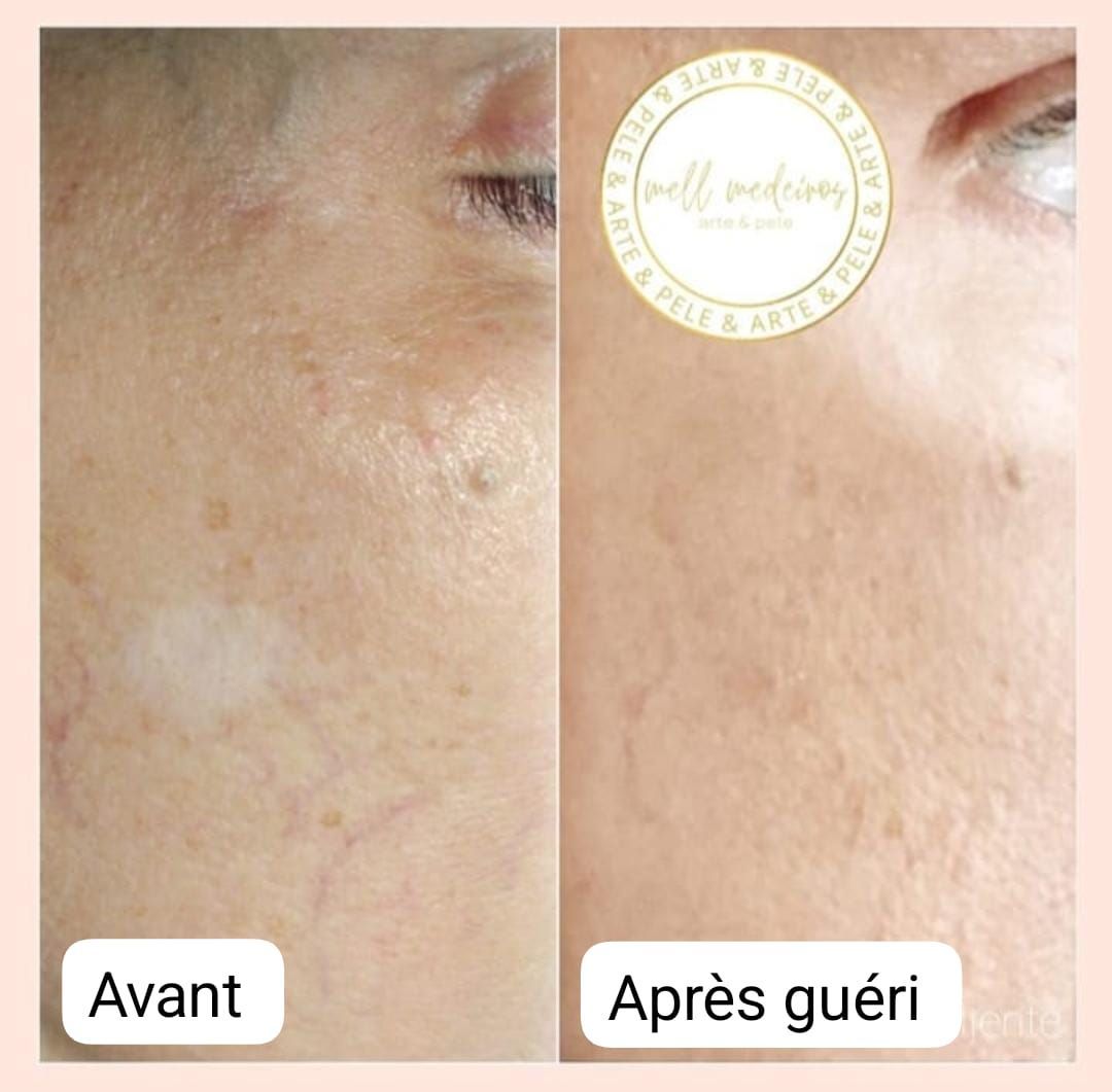 Camouflage de la peau - Melissa Medeiros - Mell Medeiros