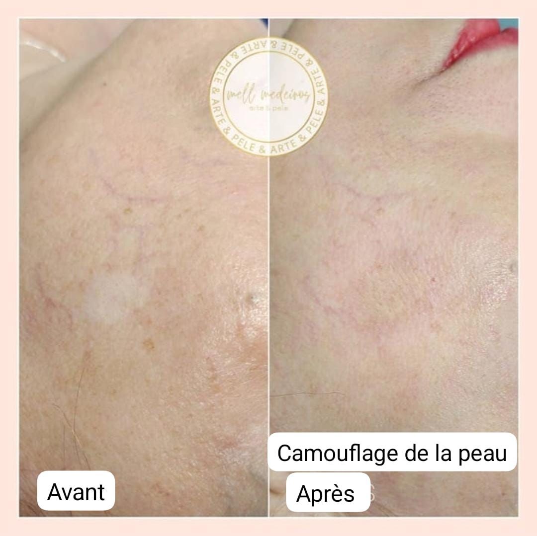 Camouflage de la peau - Melissa Medeiros - Mell Medeiros