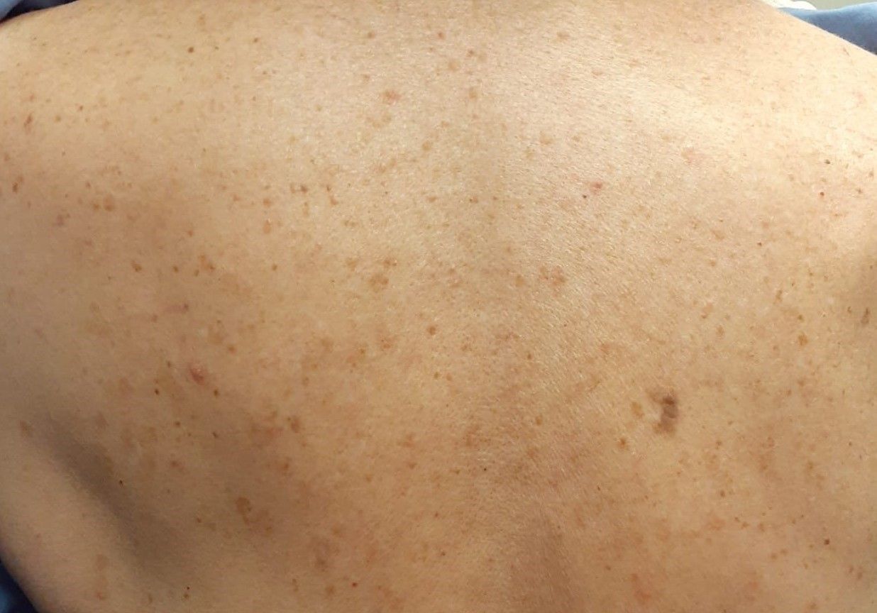 Lesions pigmentées et blanchiment, keratose