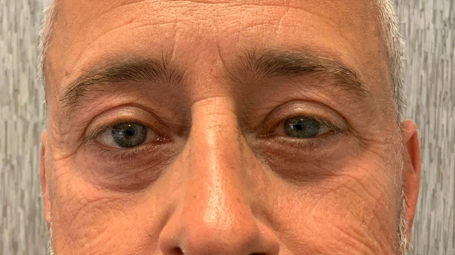 Chirurgie des paupieres inferieures