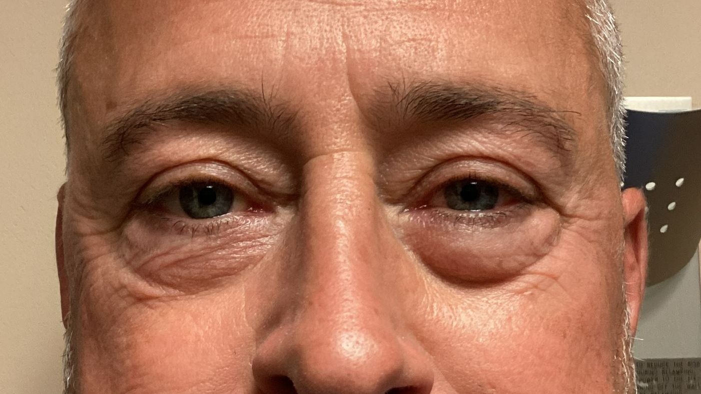 Chirurgie des paupieres inferieures