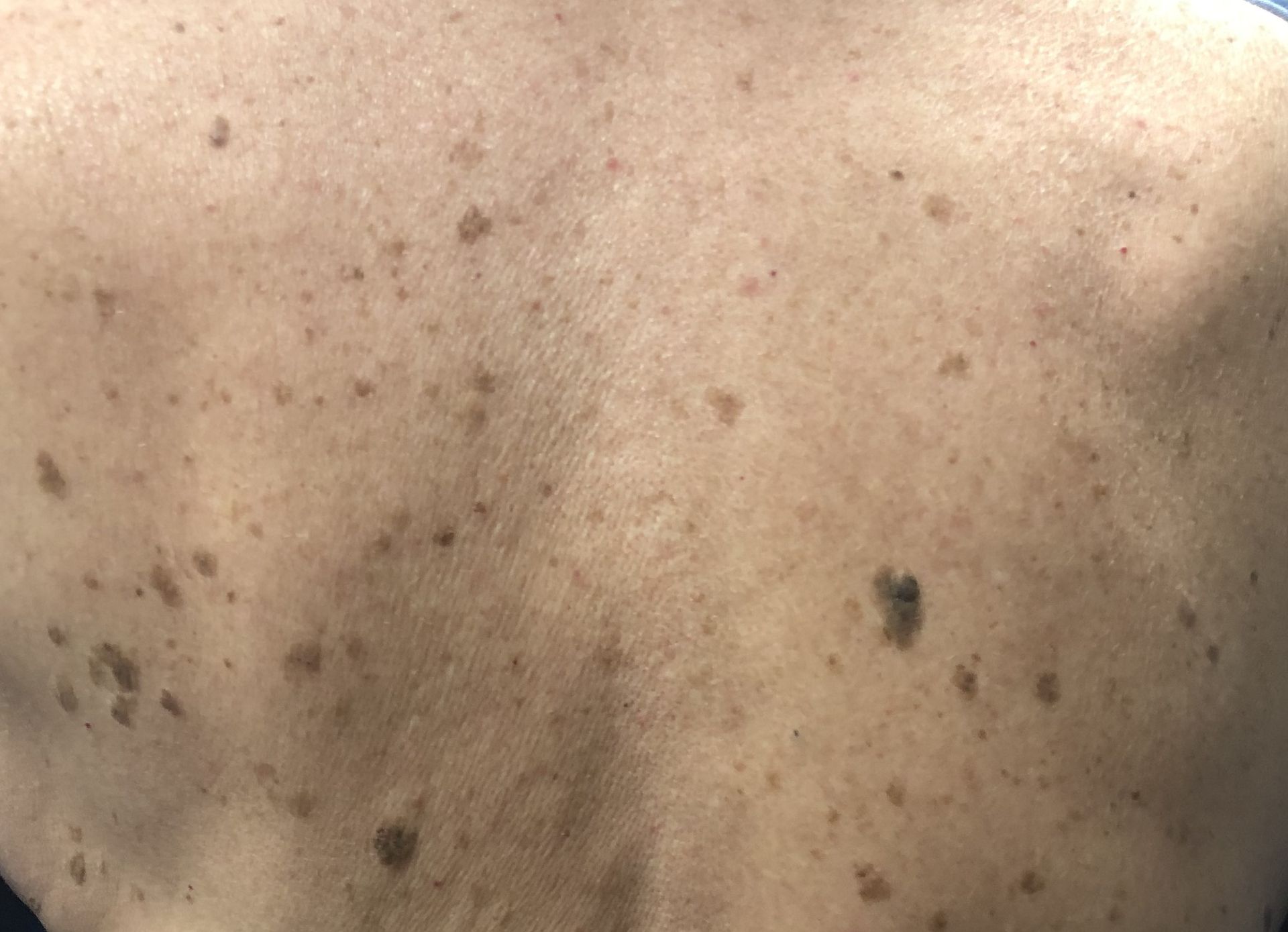 Lesions pigmentées et blanchiment