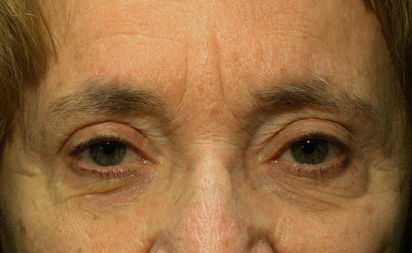 Chirurgie des paupières supérieures