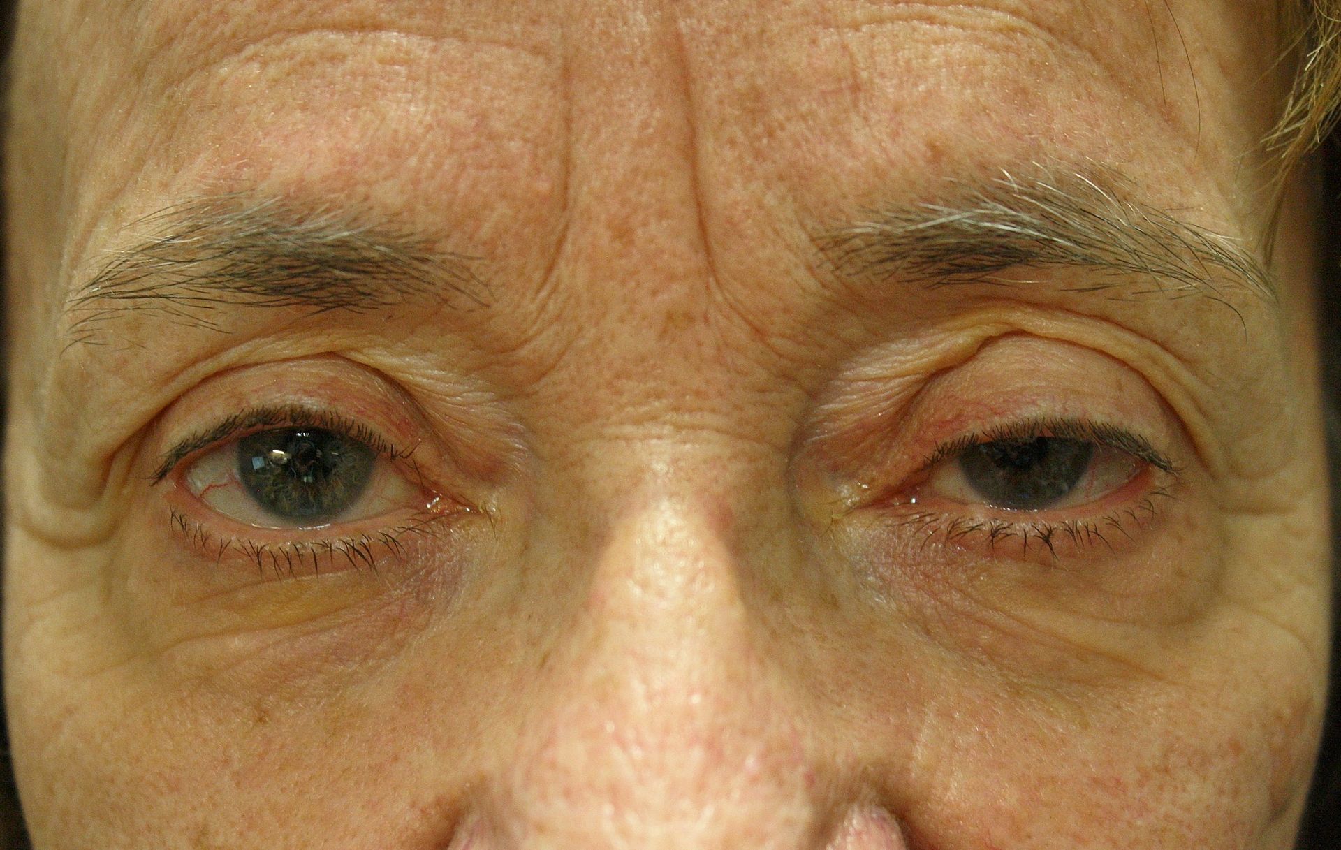 Chirurgie des paupières supérieures