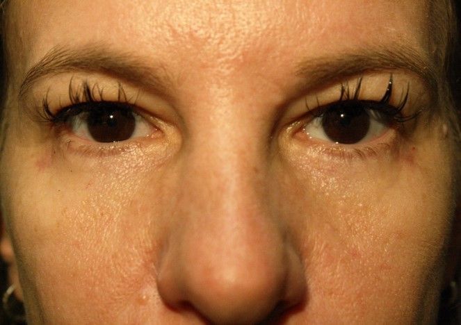 Chirurgie des paupieres inferieures