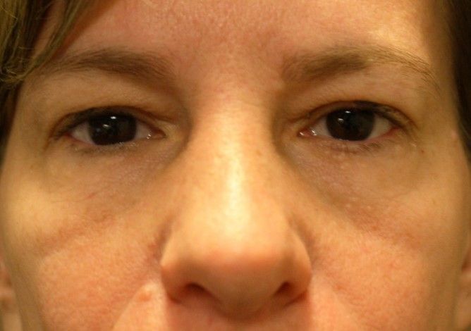 Chirurgie des paupieres inferieures