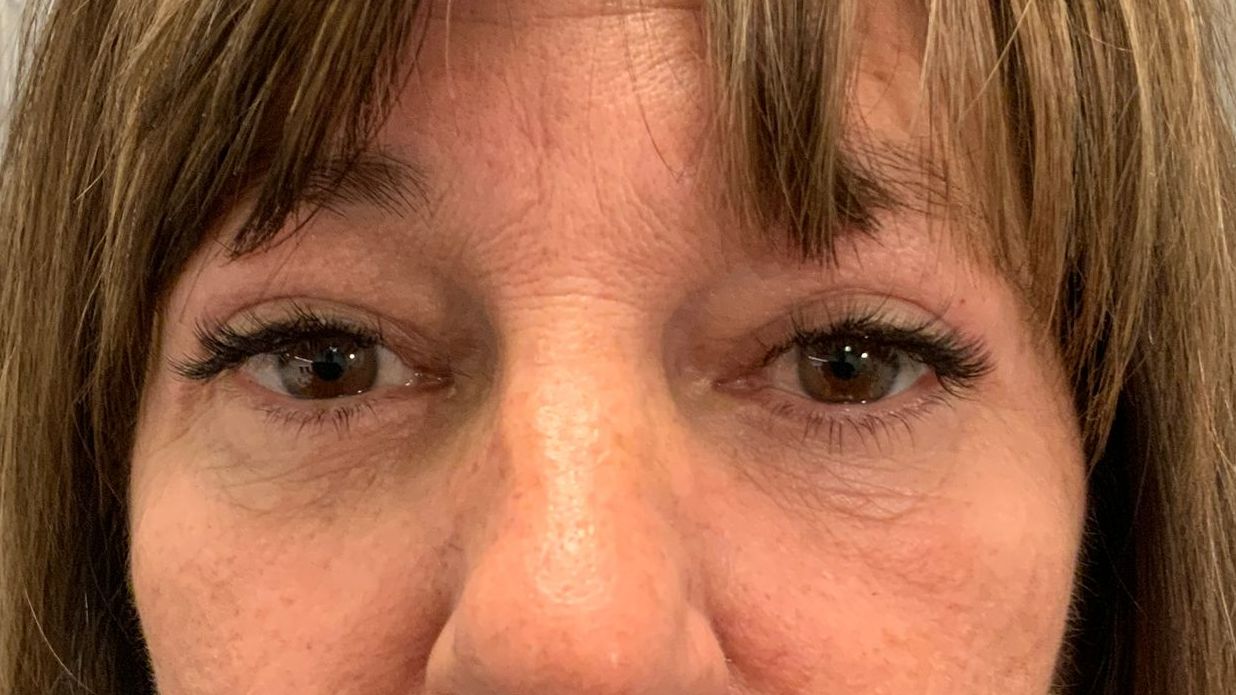 Chirurgie des 4 paupières