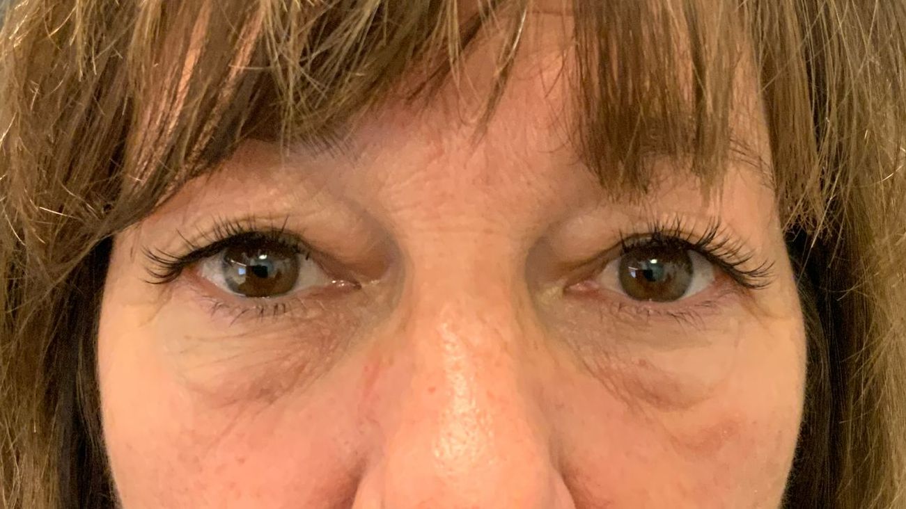 Chirurgie des 4 paupières