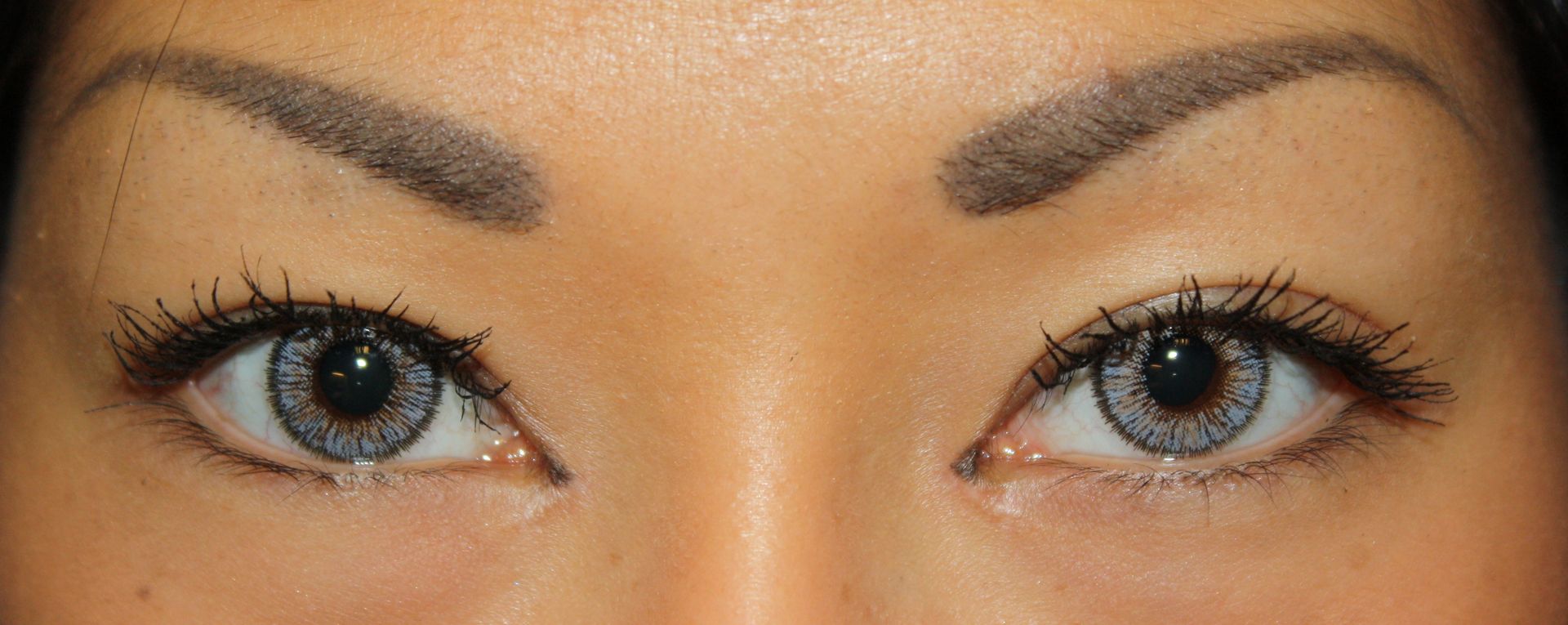 Chirurgie des paupieres asiatiques