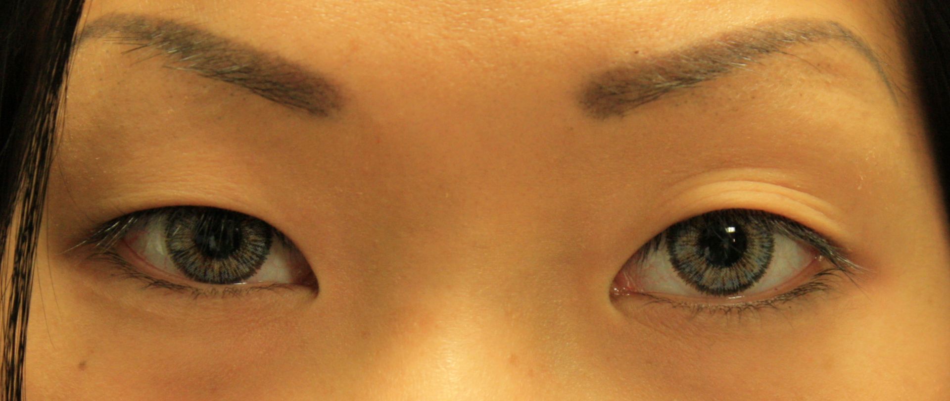 Chirurgie des paupieres asiatiques