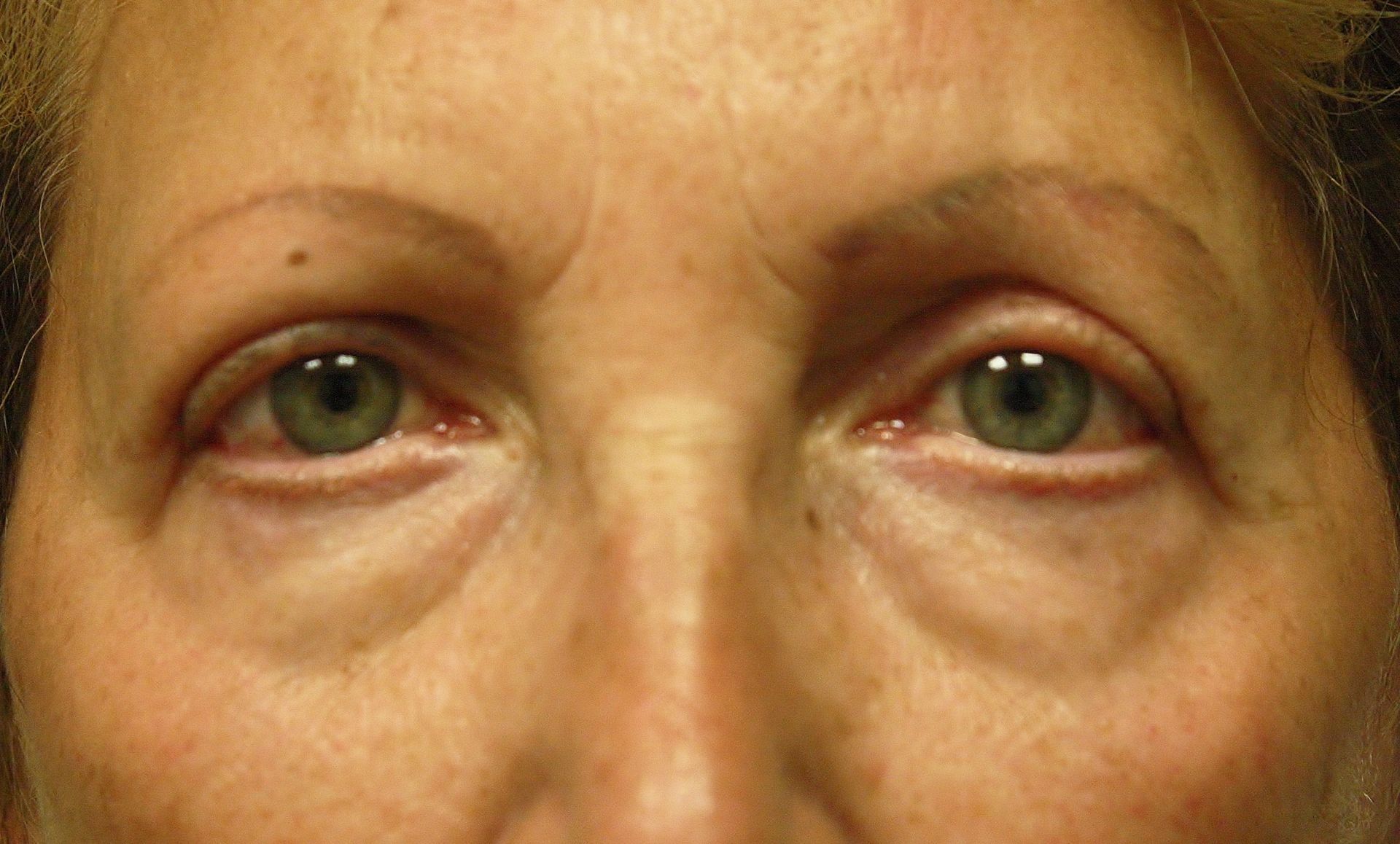 Chirurgie des paupières supérieures