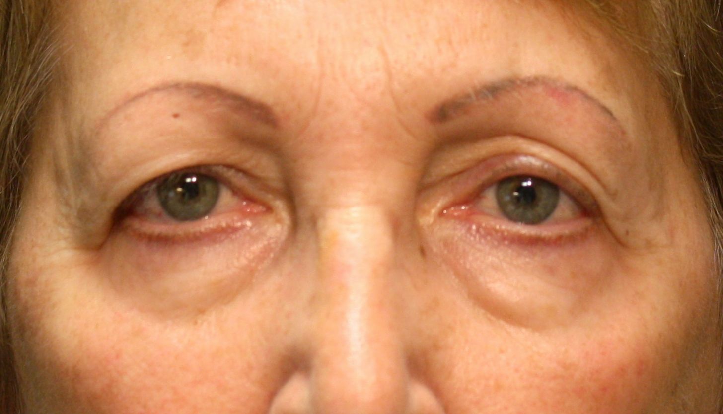 Chirurgie des paupières supérieures