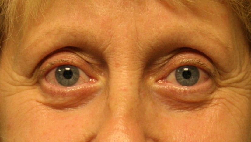 Chirurgie des paupieres inferieures