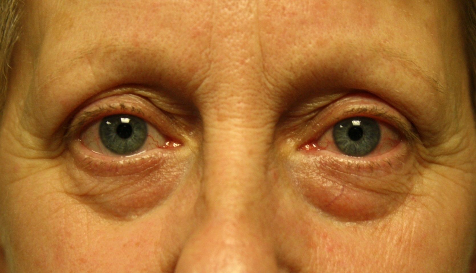 Chirurgie des paupieres inferieures