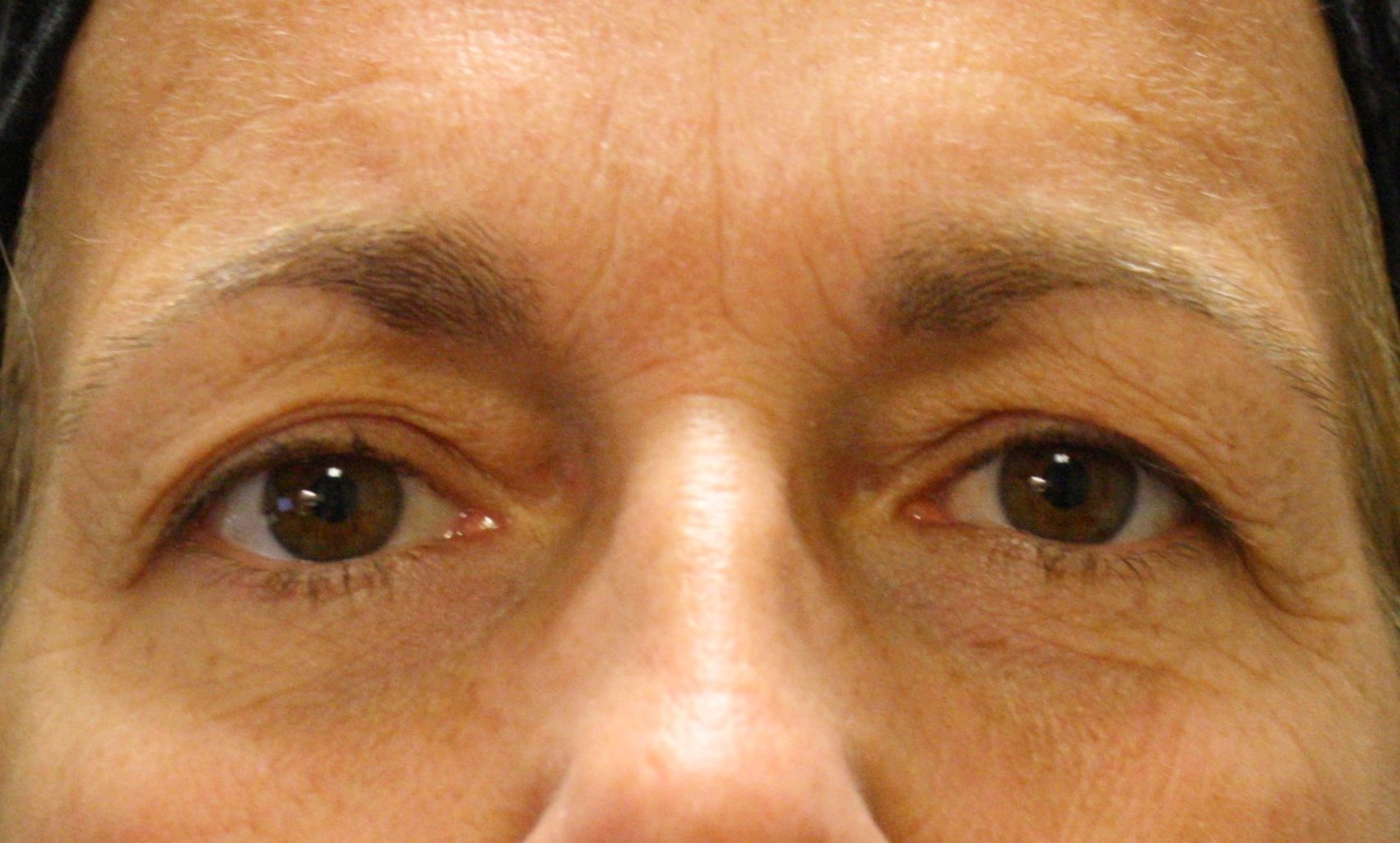 Chirurgie des paupières supérieures