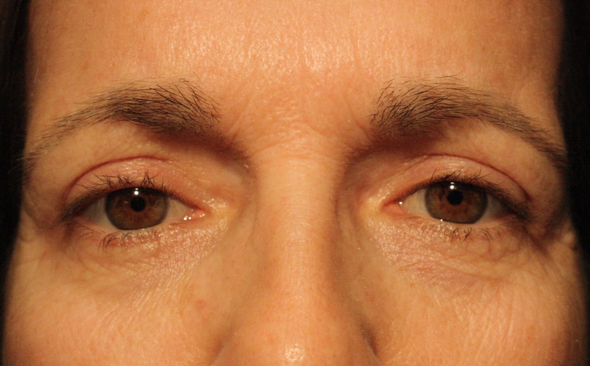 Chirurgie des paupières supérieures