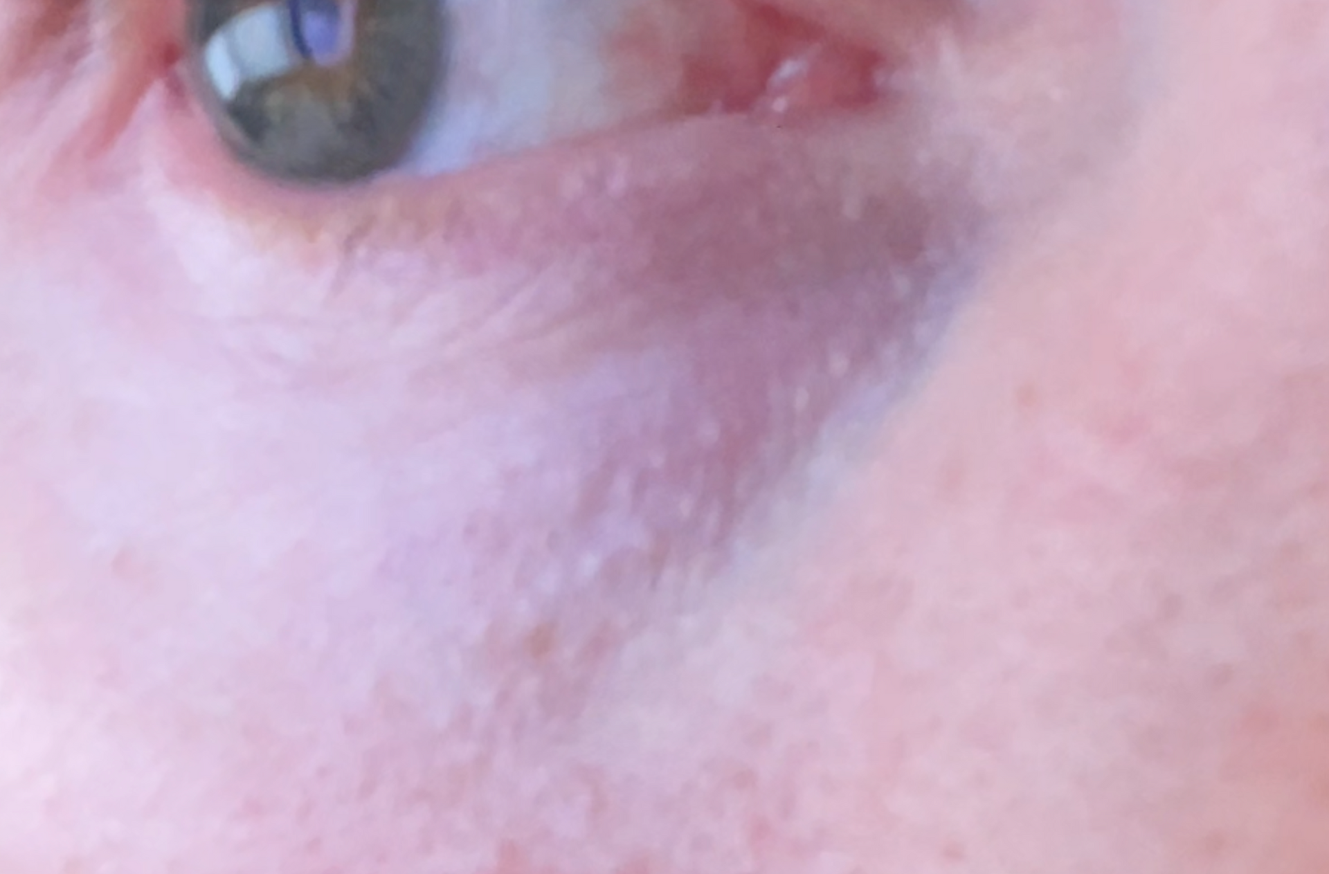 Verrues, Papillomes et Syringomes