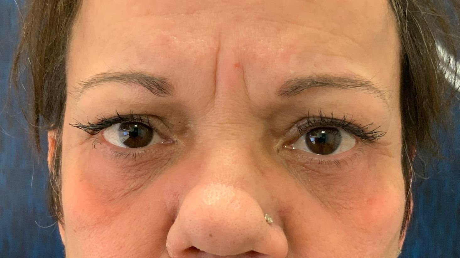 Chirurgie des paupieres inferieures