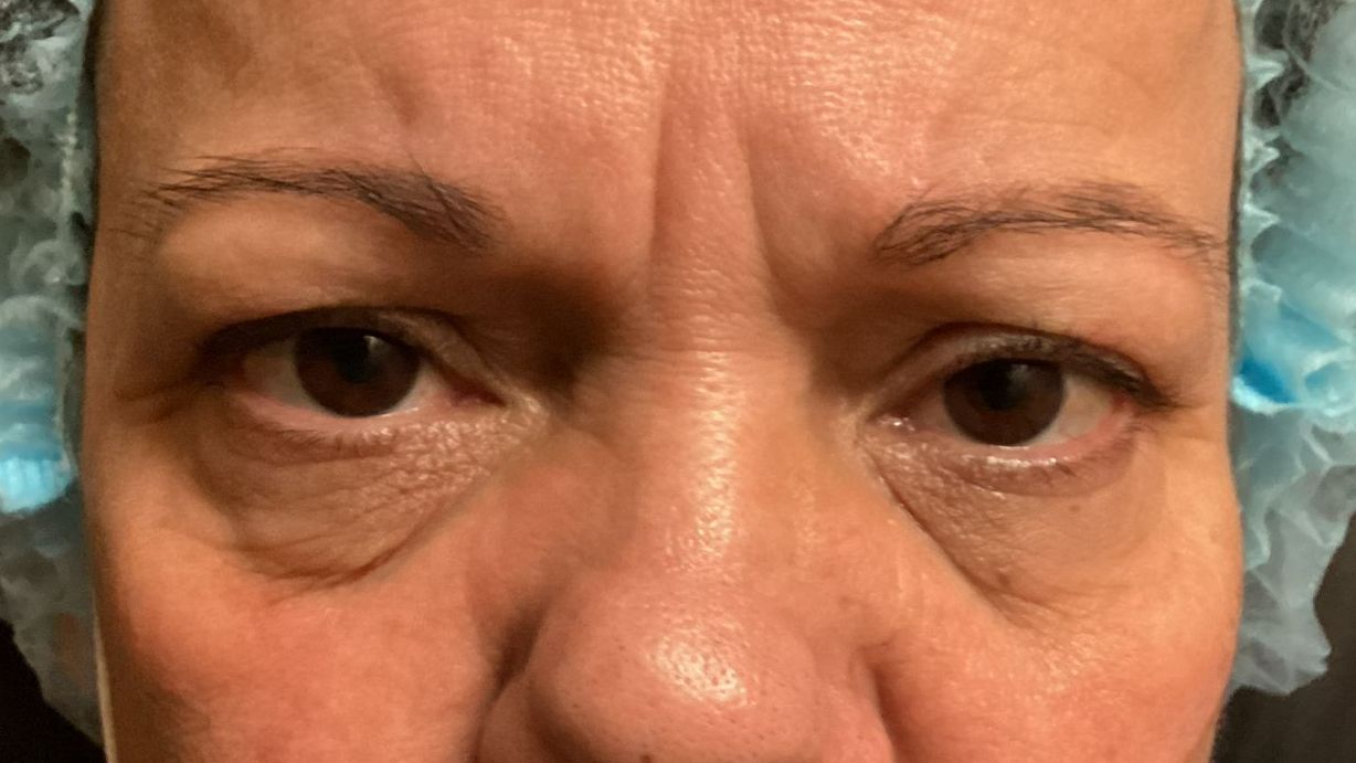 Chirurgie des paupieres inferieures