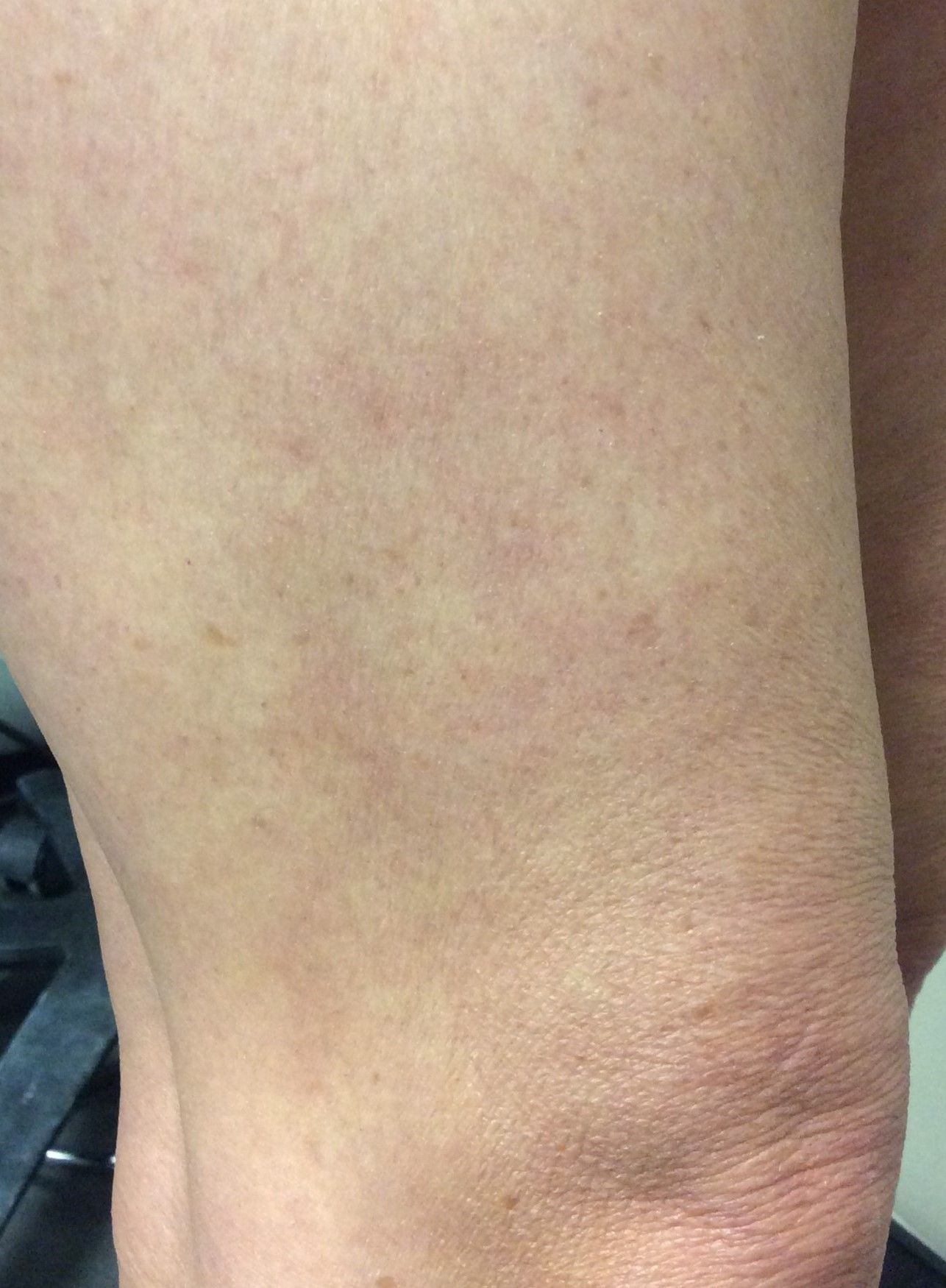 varices laser dynamis