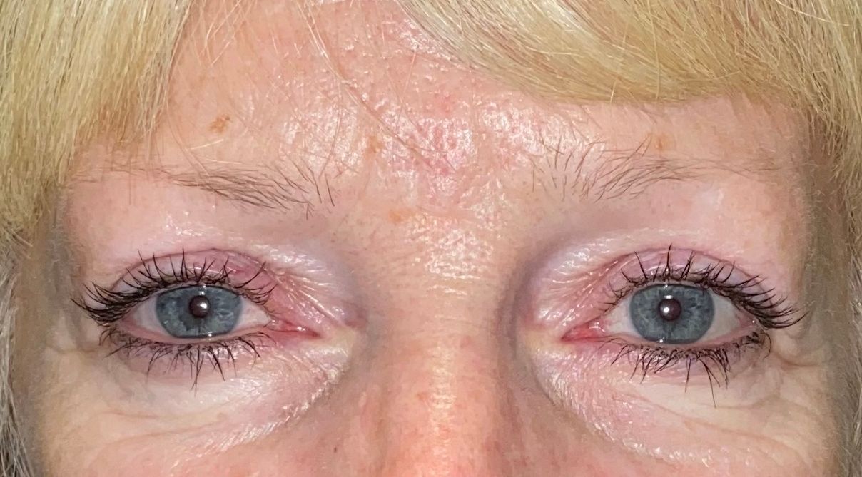 Chirurgie des paupières supérieures