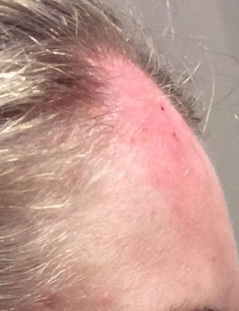 Agents de comblement