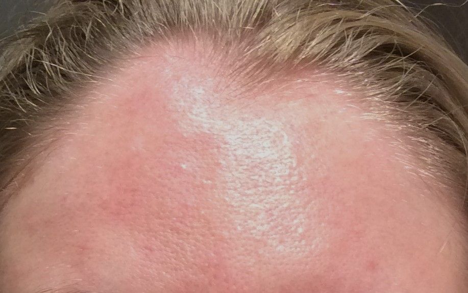 agent de comblement, front