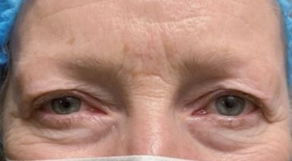 Chirurgie des paupières supérieures