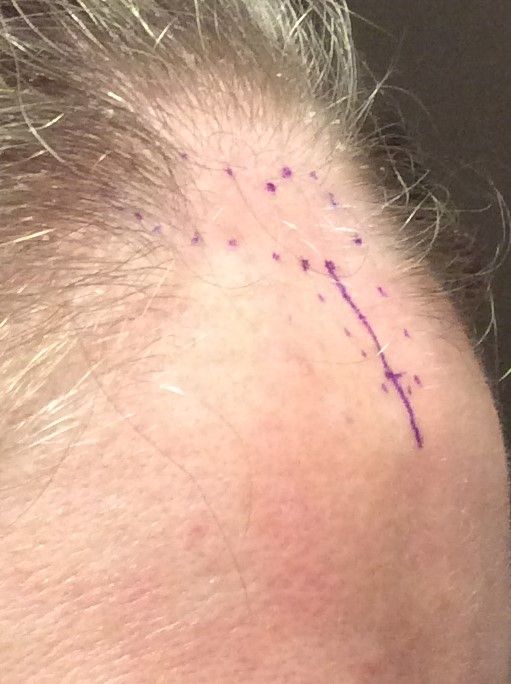 Agents de comblement