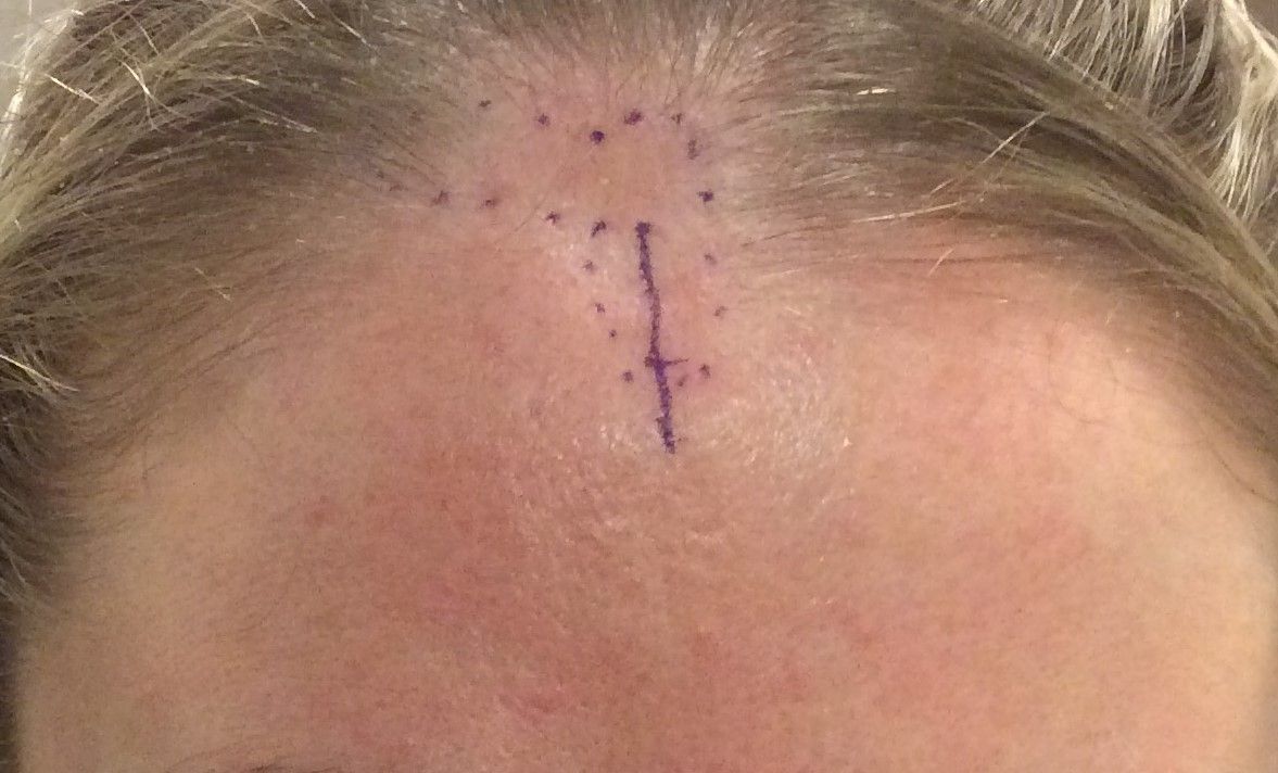 agent de comblement, front