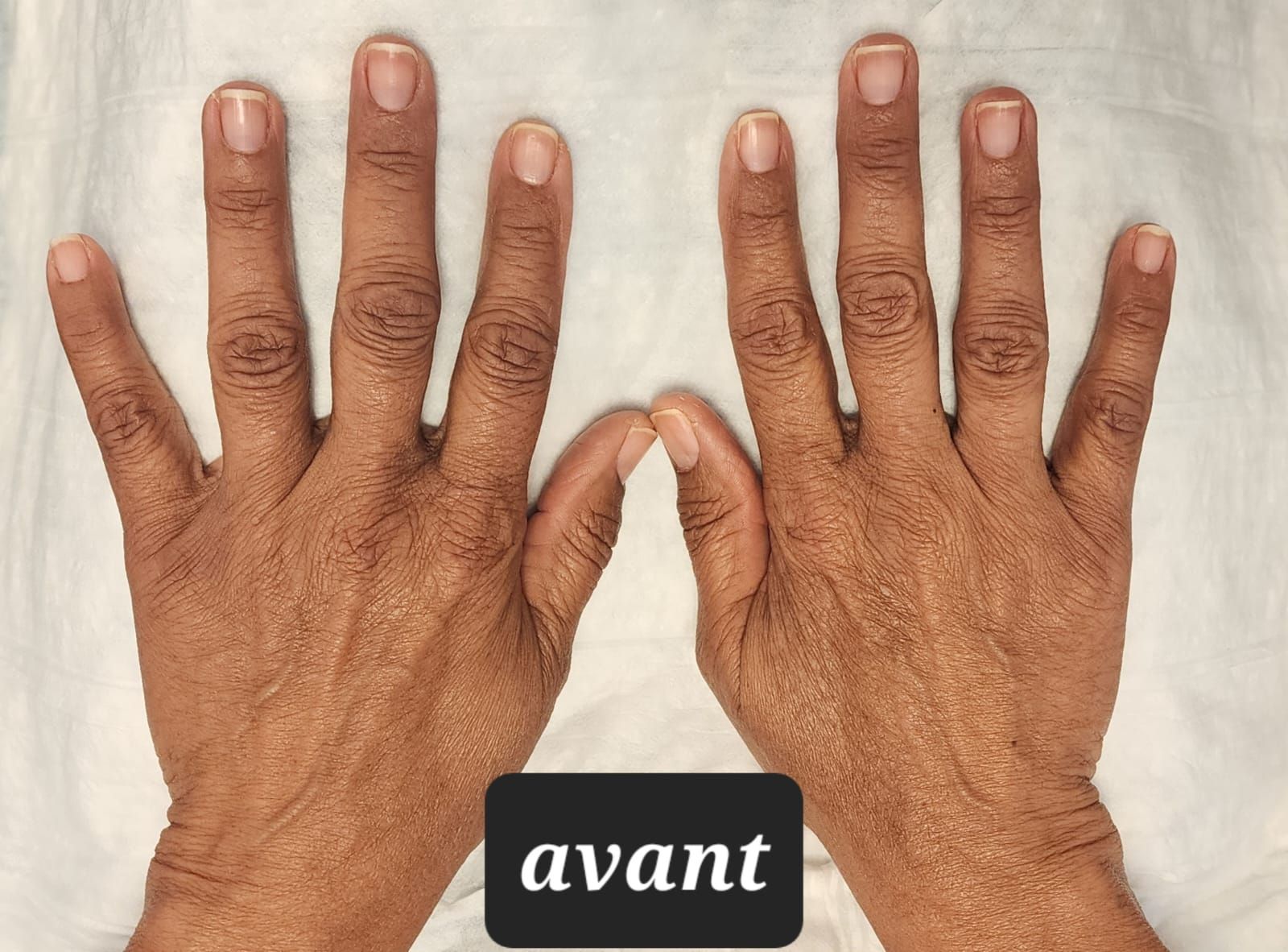 agent de comblement, mains