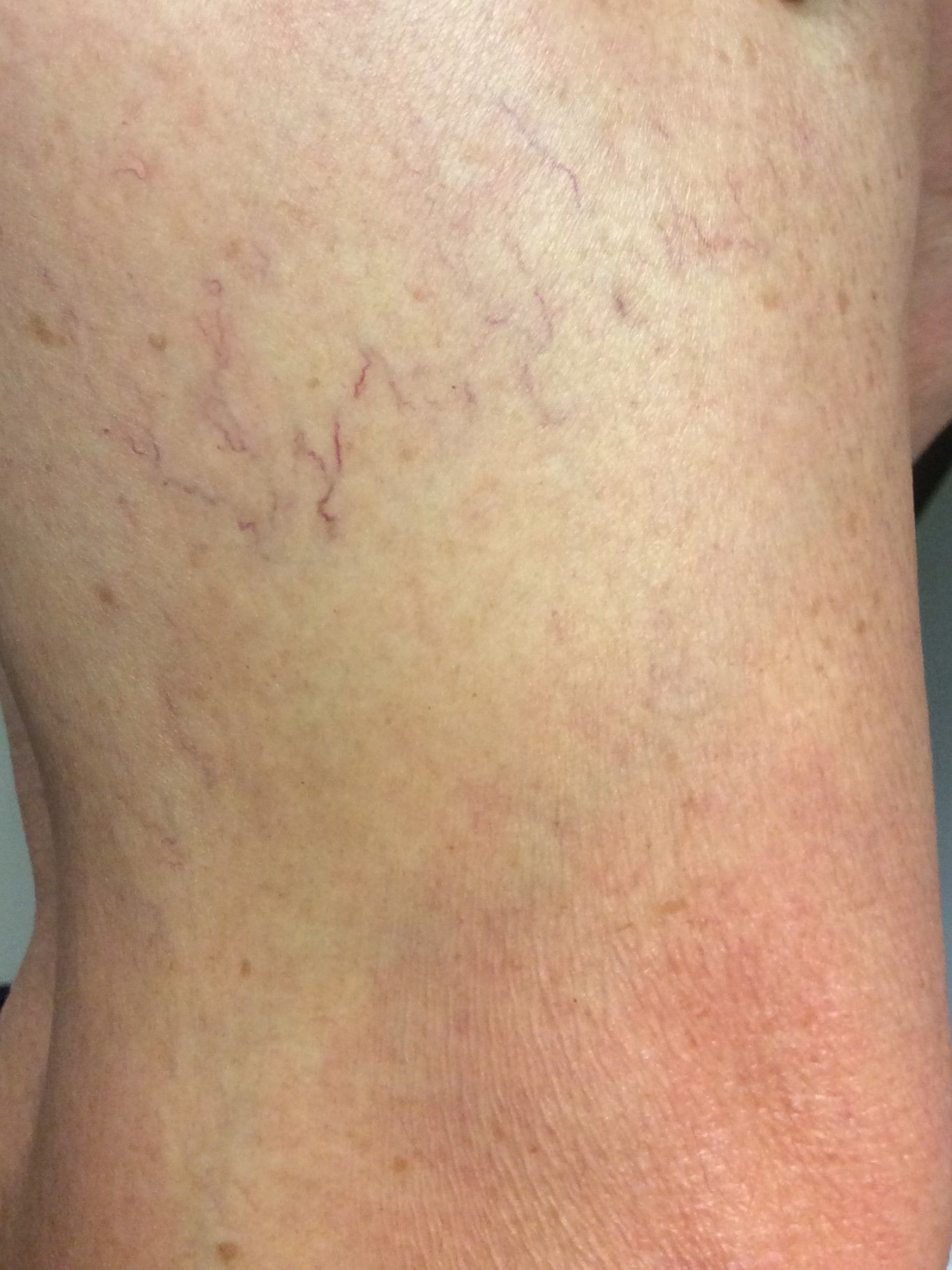 varices laser dynamis