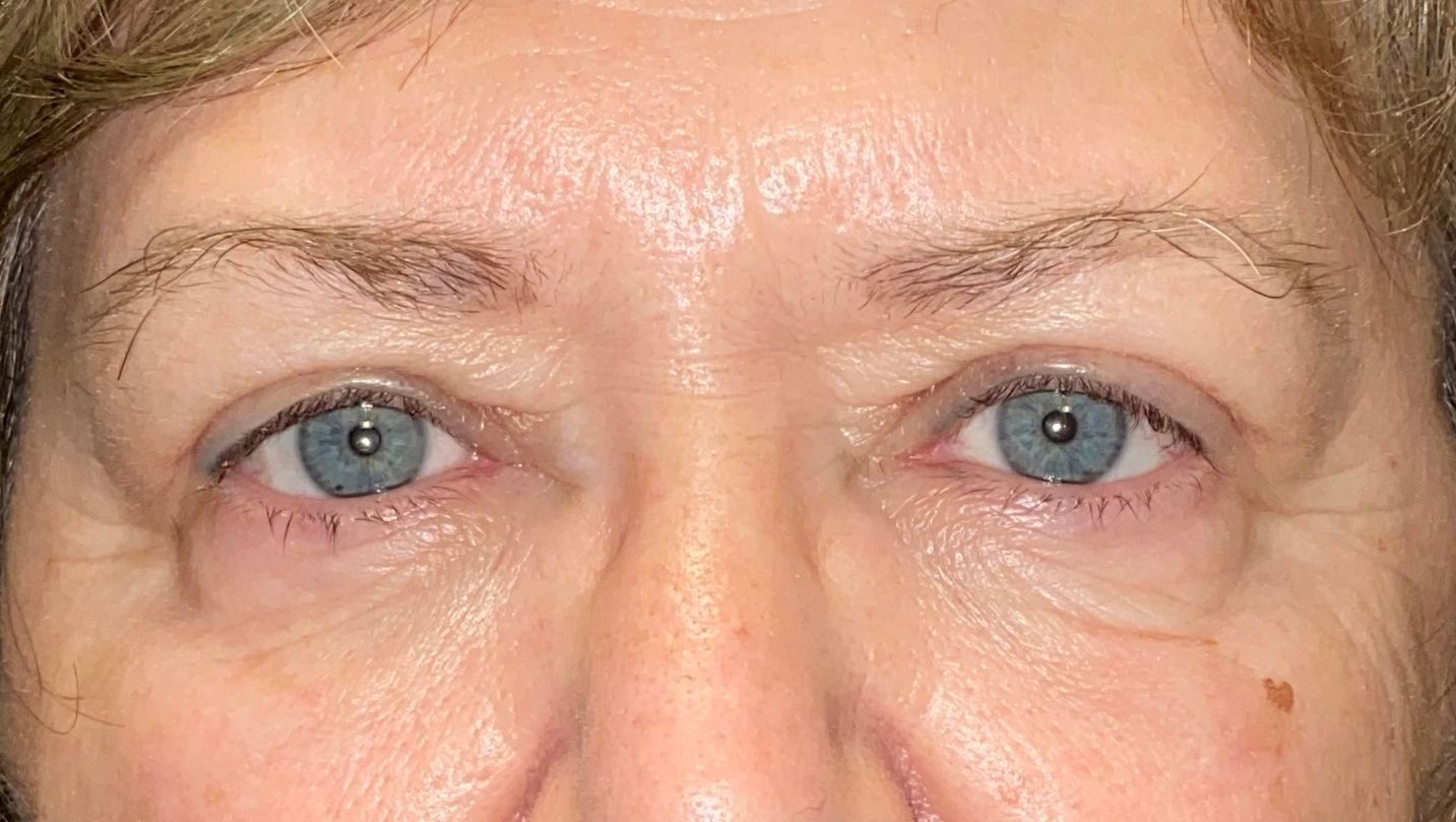 Chirurgie des paupières supérieures