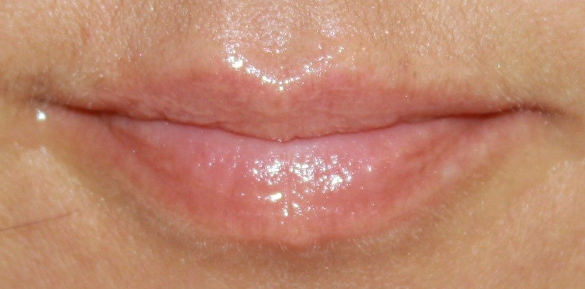 agents de comblement, fillers, lèvres, 