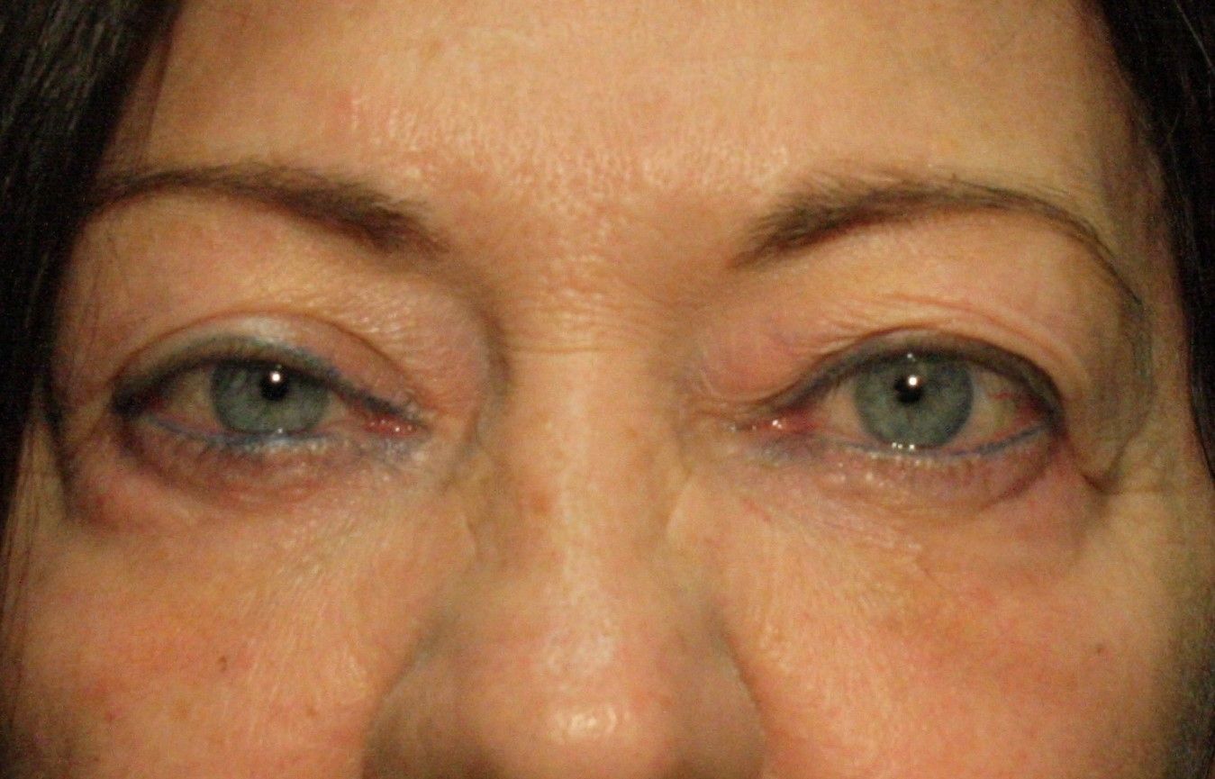 agent de comblement, yeux