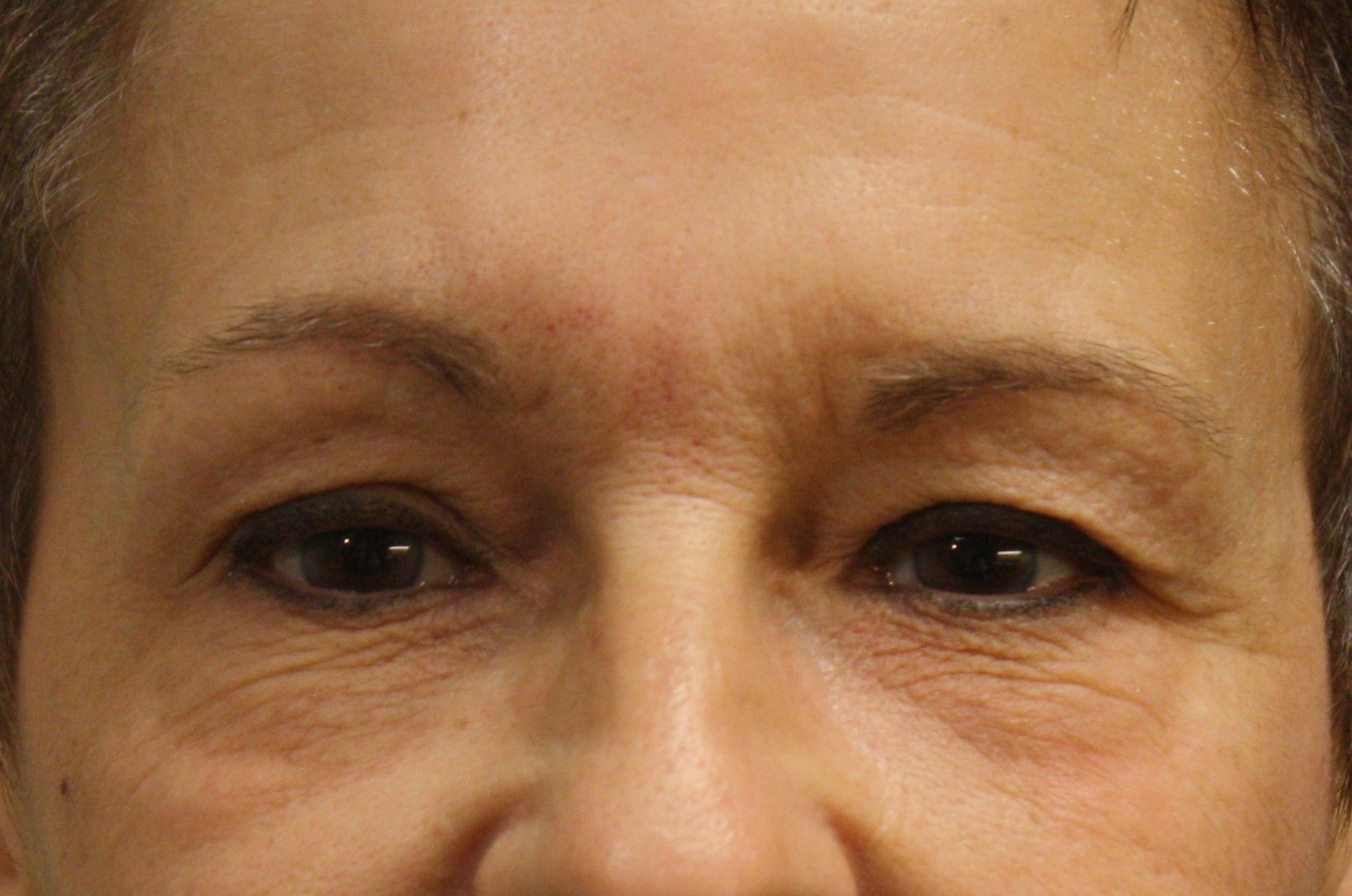 agent de comblement, yeux