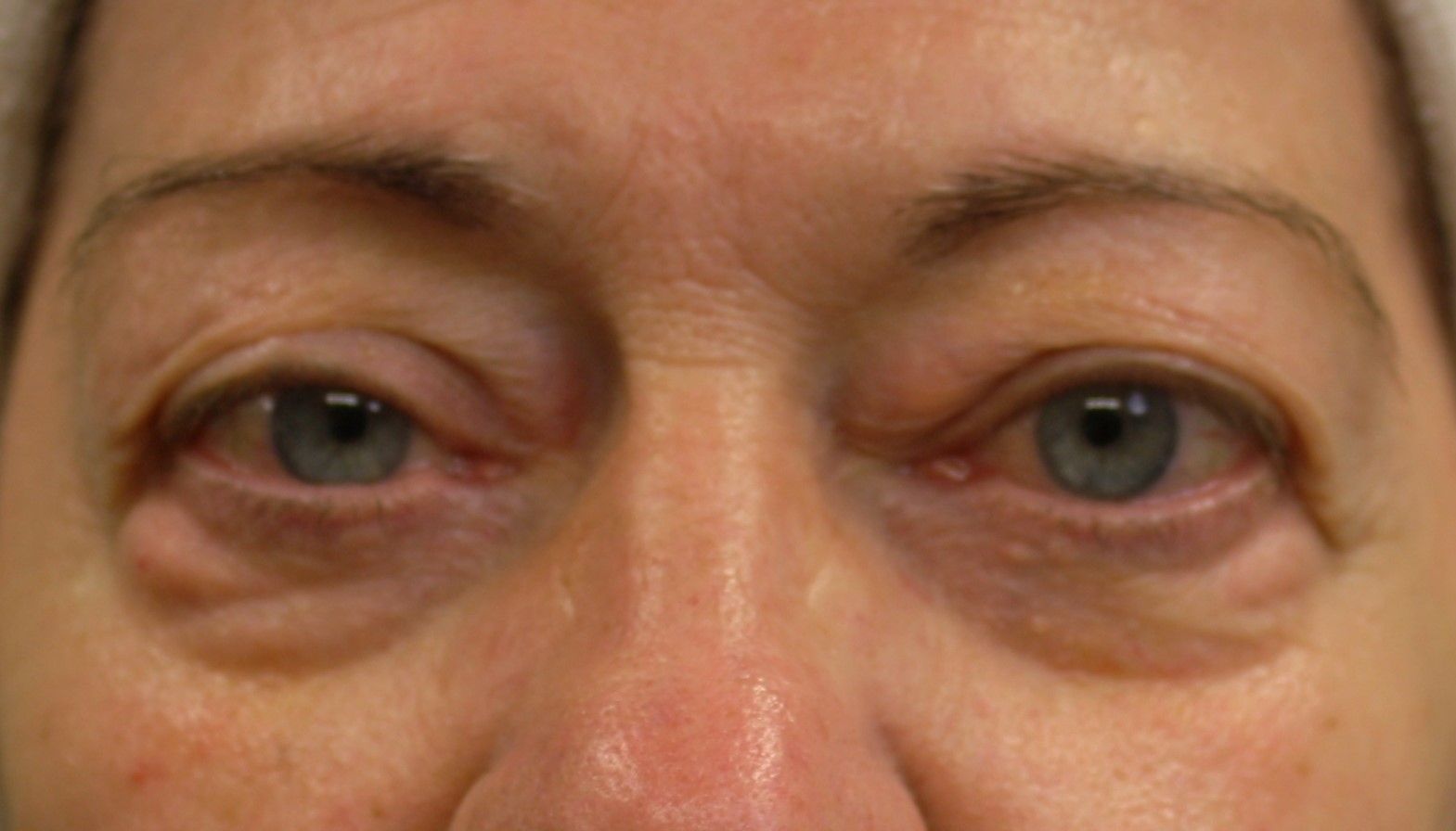 agent de comblement, yeux