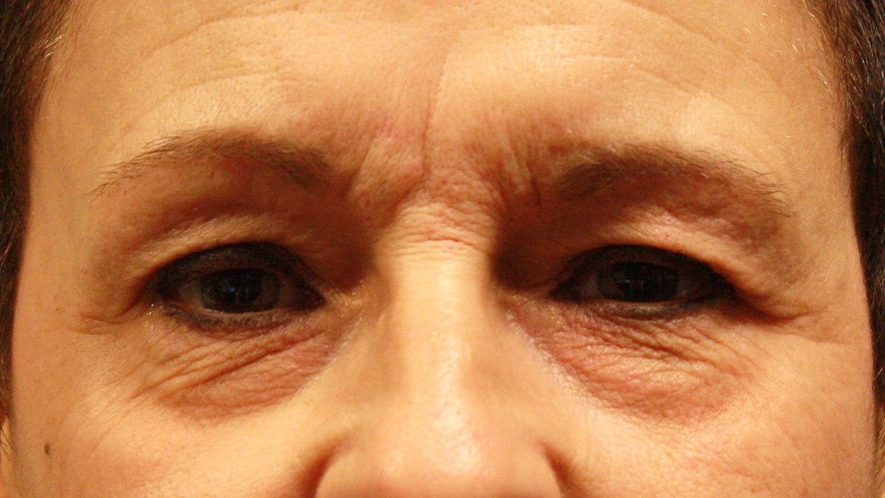 agent de comblement, yeux