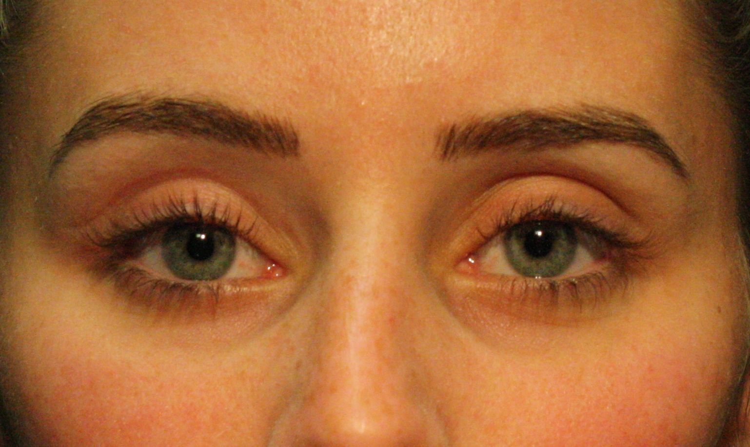 agent de comblement, yeux