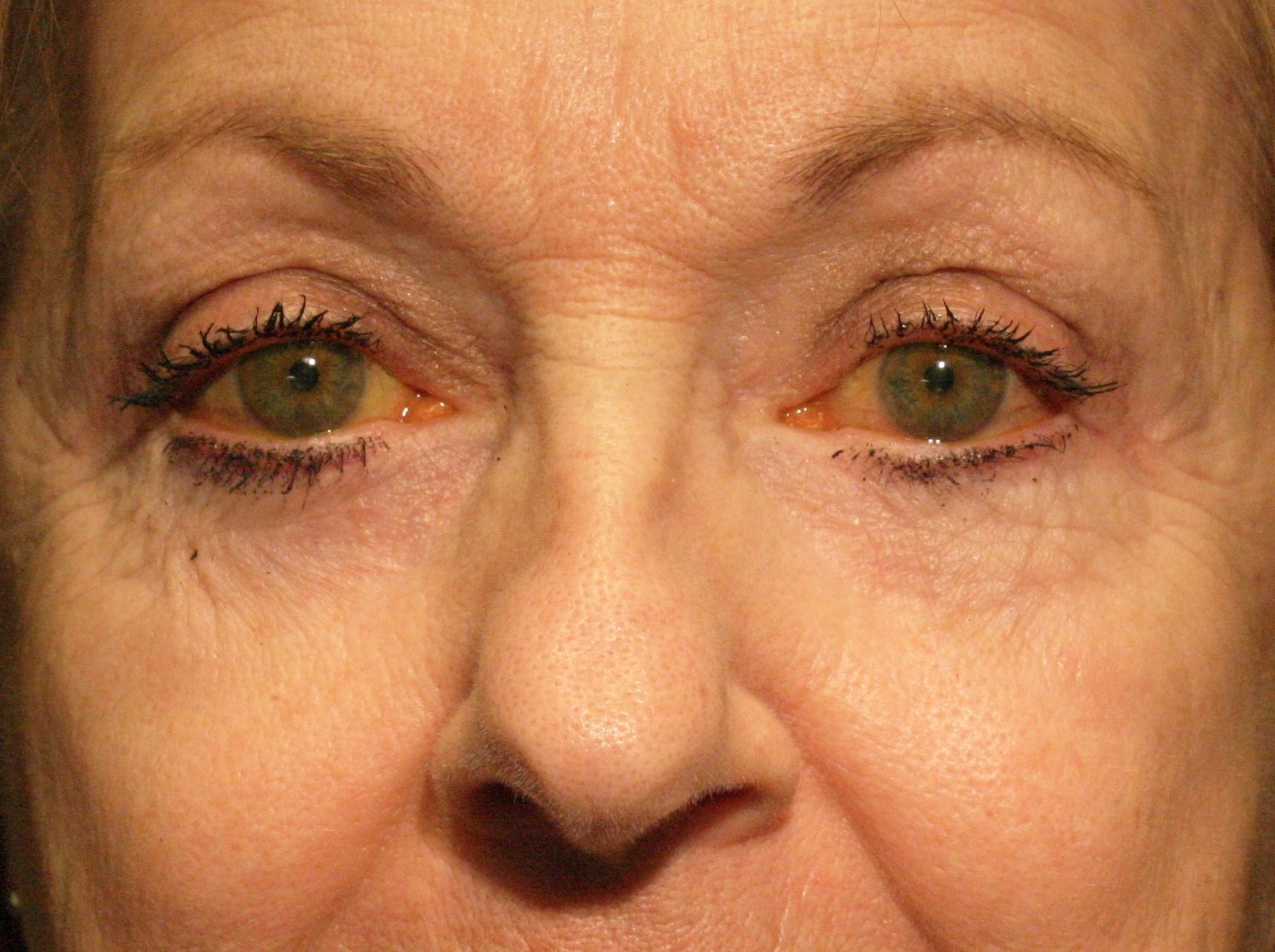 transposition de gras