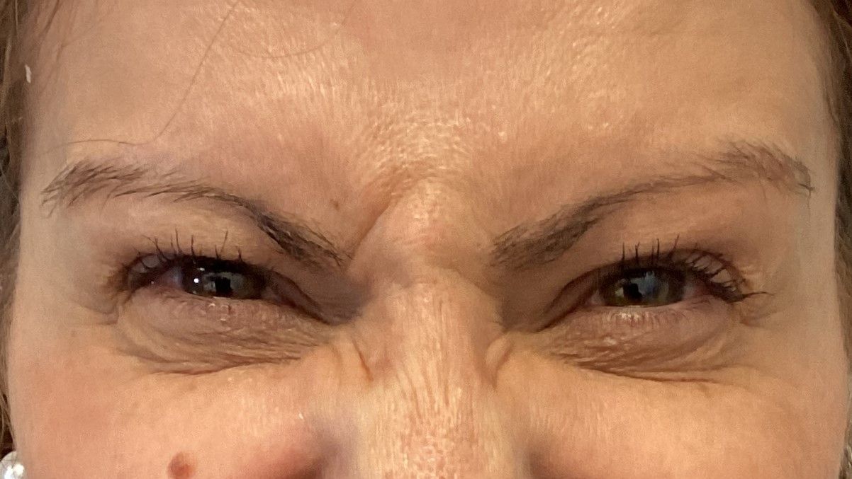 botox, sourcils, glabelle