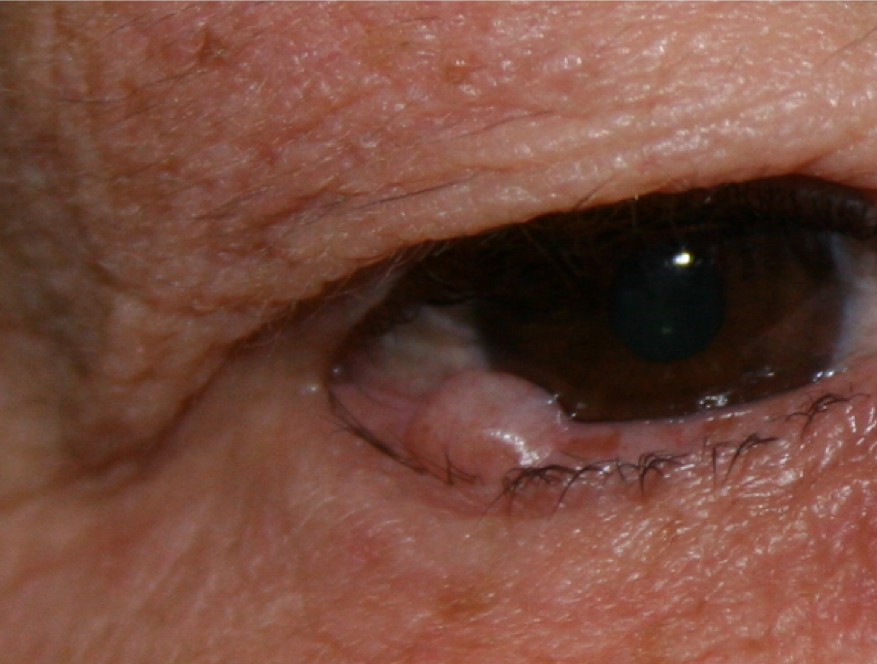 Grains de beauté (Naevus)