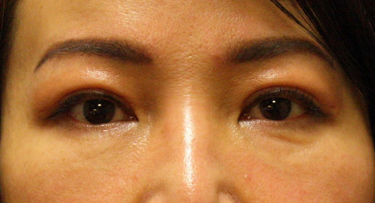 Chirurgie des paupieres asiatiques