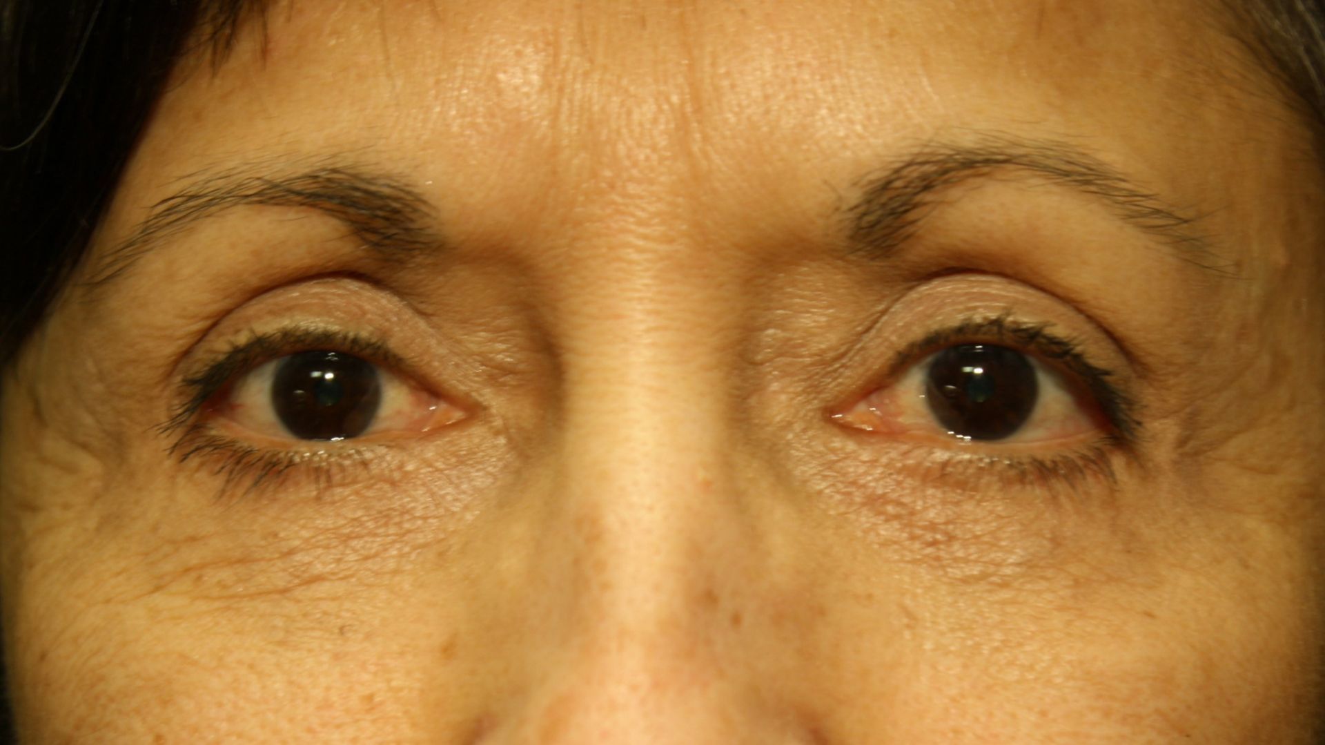 Chirurgie des 4 paupières