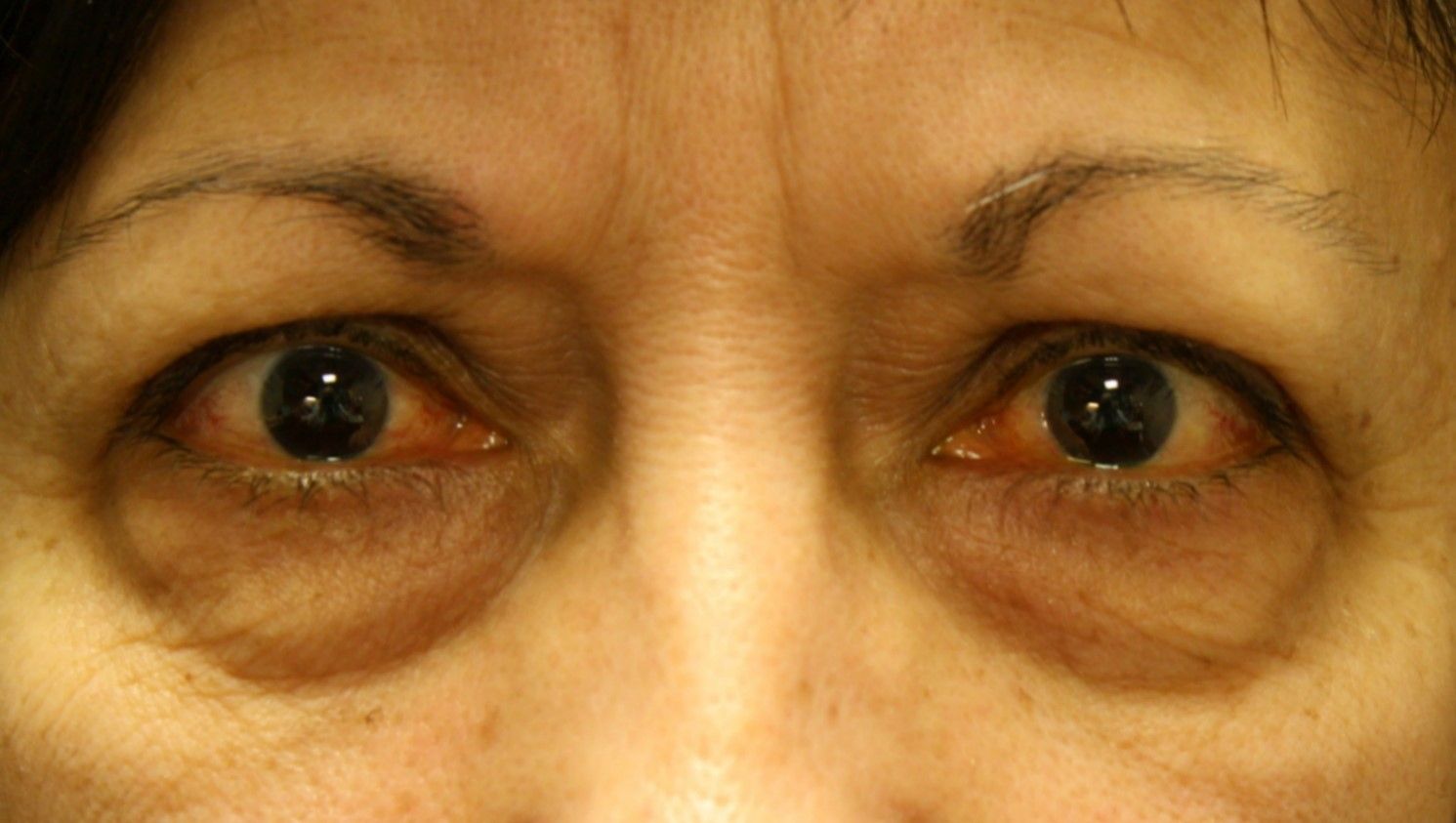 Chirurgie des 4 paupières